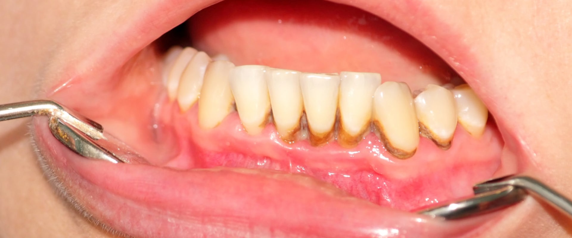 How will a dentist remove tartar?