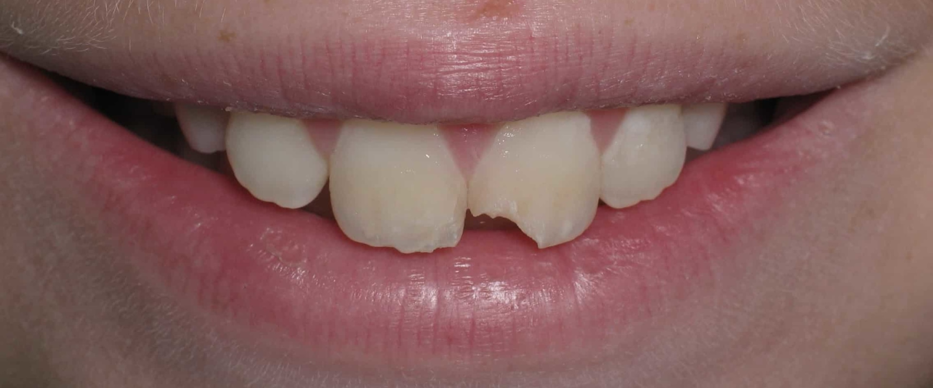 How to Fix a Chipped Tooth: Expert Advice from a Dentist