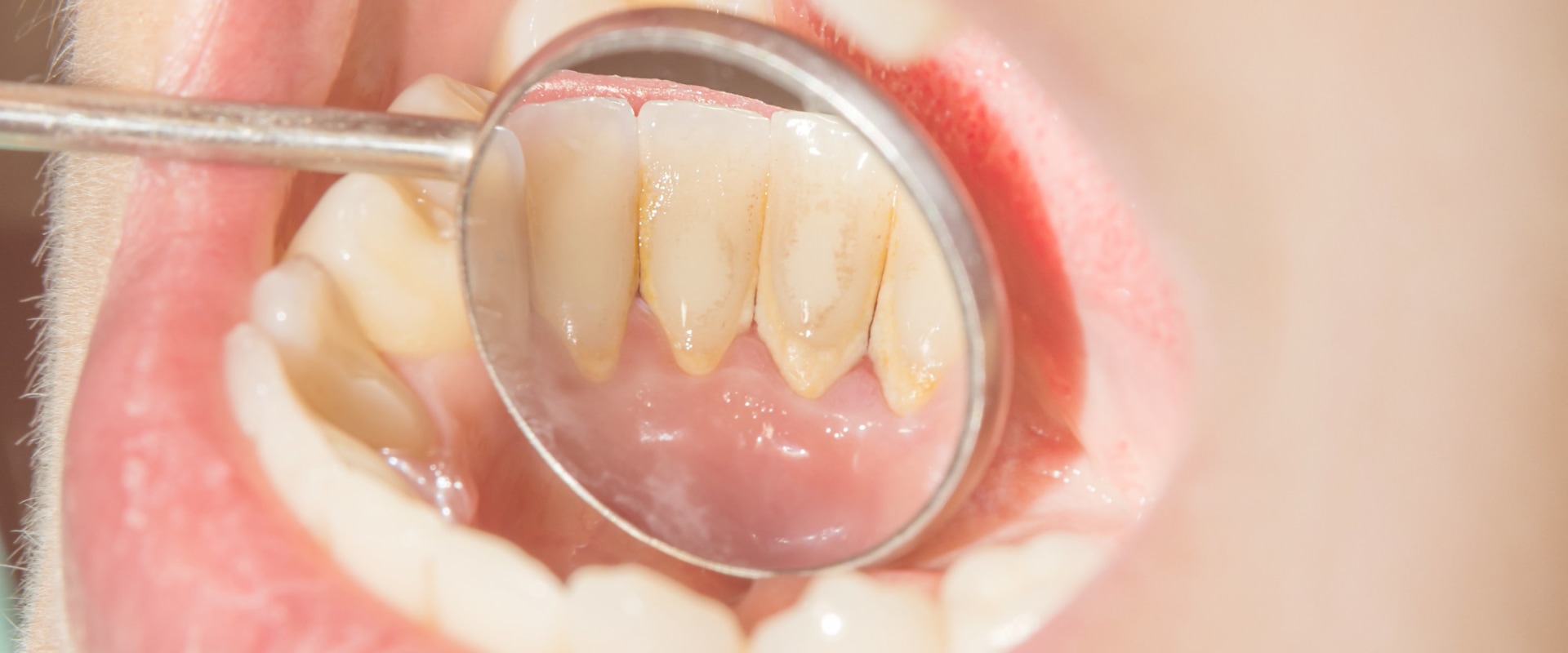 Can a Dentist Completely Remove Tartar?