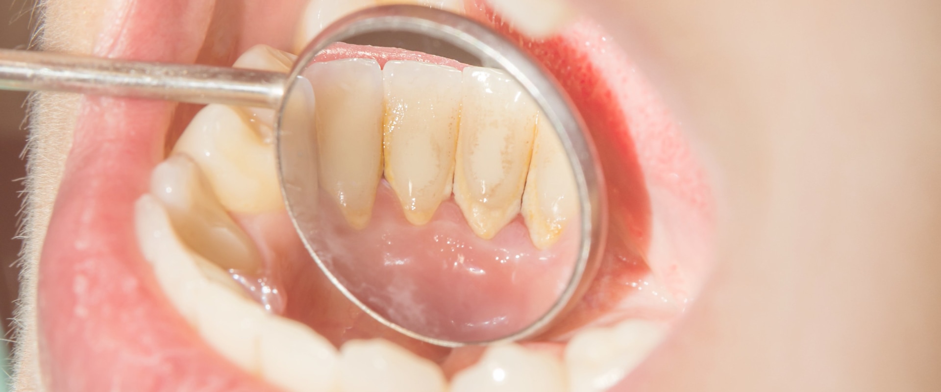 Can the dentist completely remove tartar?