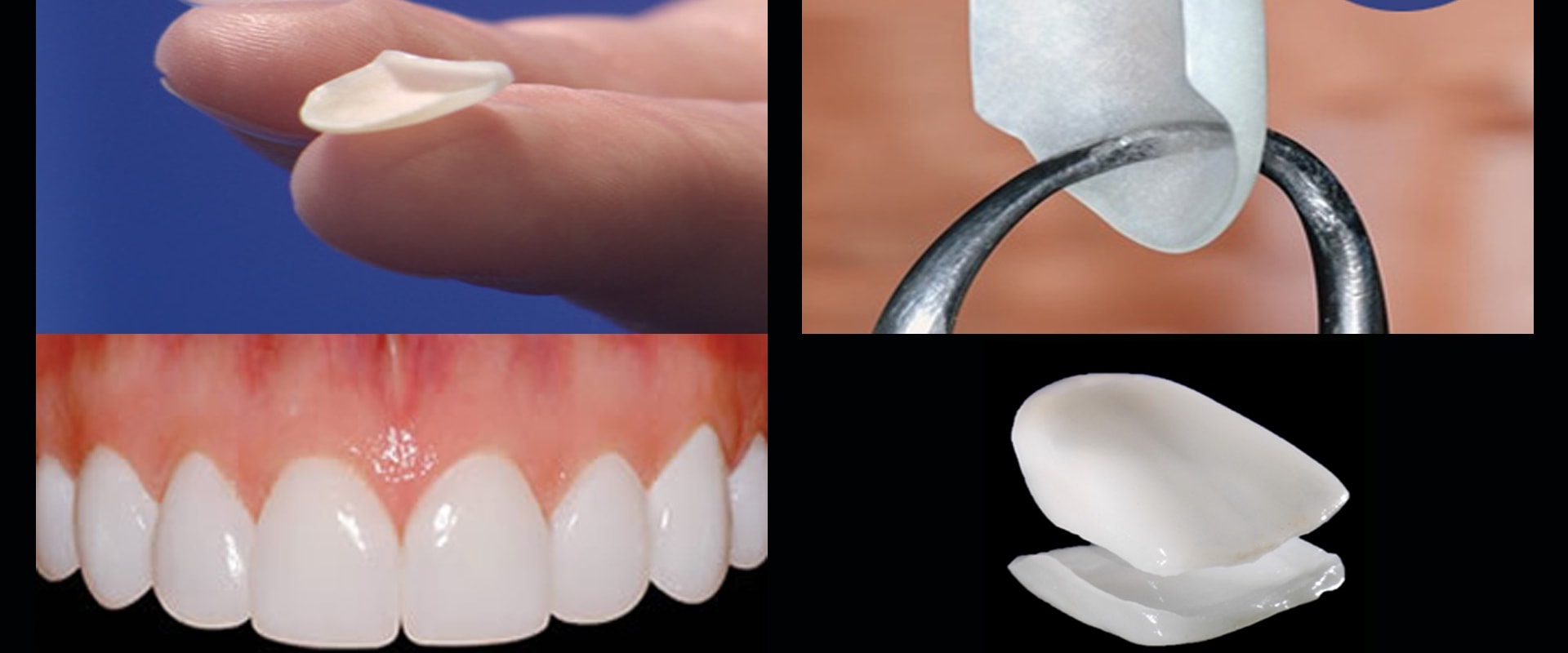 Where are the best porcelain veneers in Beverly Hills?
