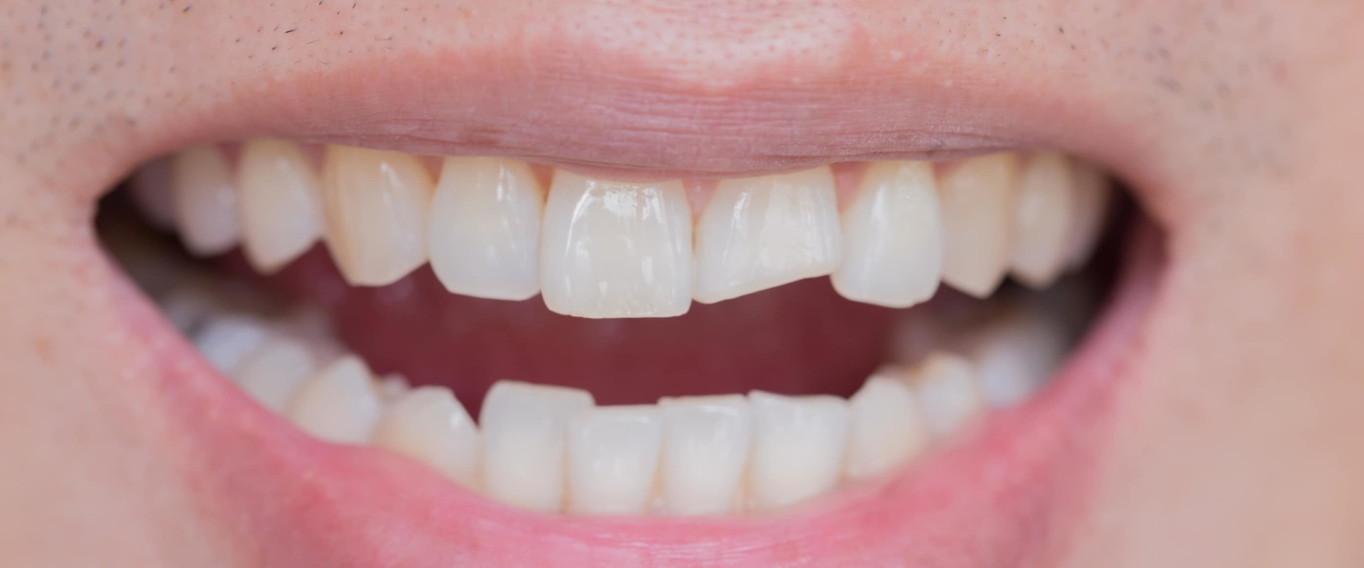 How Much Does it Cost to Fix a Chipped Front Tooth?