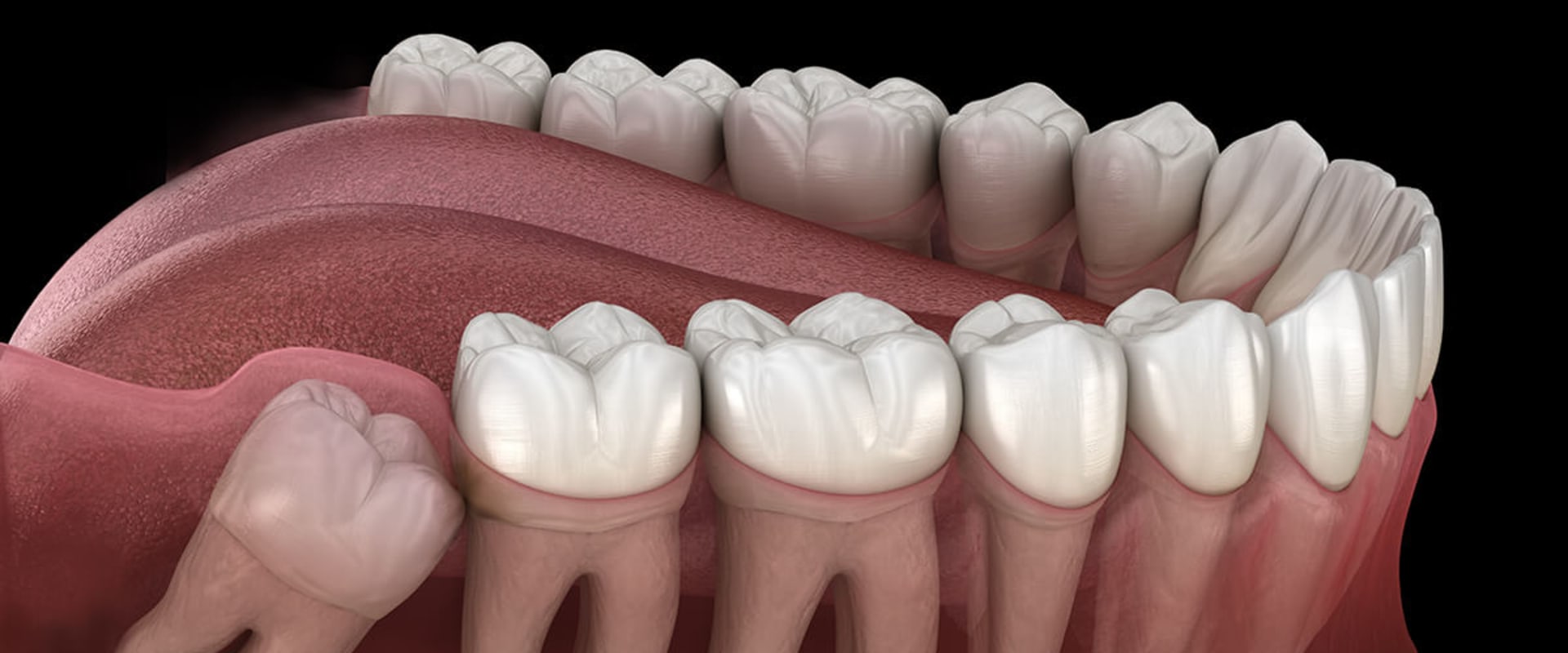 Can a normal dentist remove wisdom teeth?