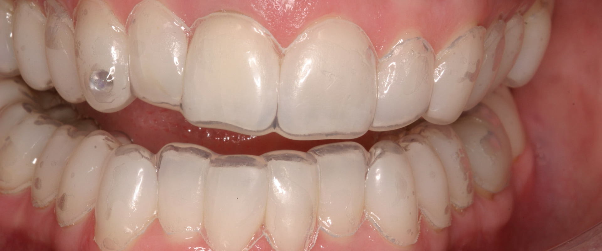 Can the dentist whiten teeth?