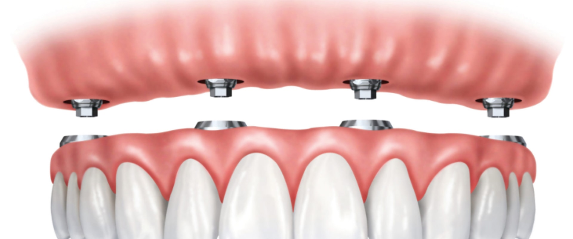 Finding the Right Dentist for Your Dentures