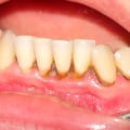 How to Remove Tartar: A Guide from a Dentist Expert