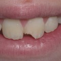 How to Fix a Chipped Tooth: Expert Advice from a Dentist