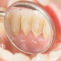 Can a Dentist Completely Remove Tartar?