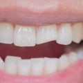 How Much Does it Cost to Fix a Chipped Front Tooth?