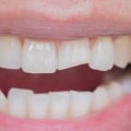 How much does it cost to fix a chipped front tooth?