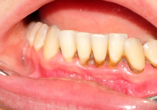 How will a dentist remove tartar?