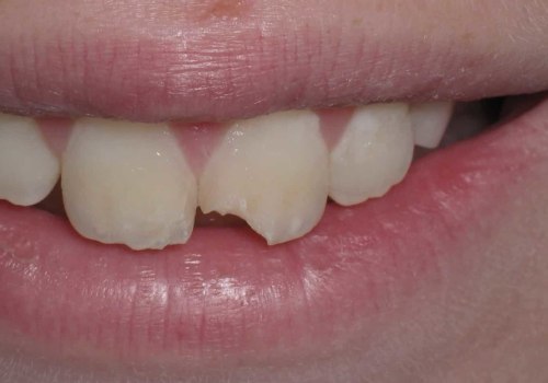 How does the dentist fix a chipped tooth?
