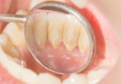 Can the dentist completely remove tartar?