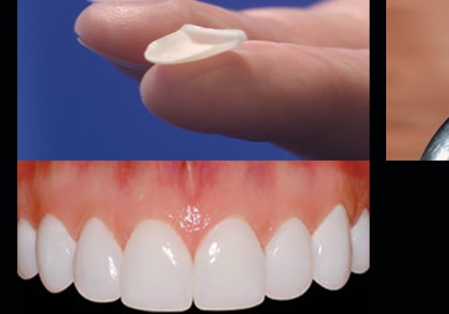 Where are the best porcelain veneers in Beverly Hills?