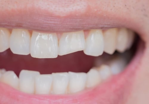 How much does it cost to fix a chipped front tooth?