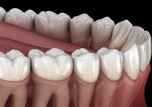 Do I Need an Oral Surgeon to Remove My Wisdom Teeth?