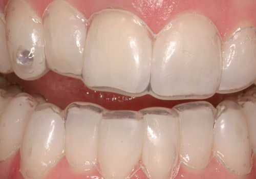 Can the dentist whiten teeth?