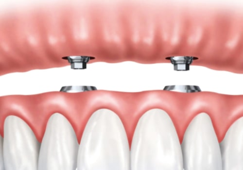 Finding the Right Dentist for Your Dentures